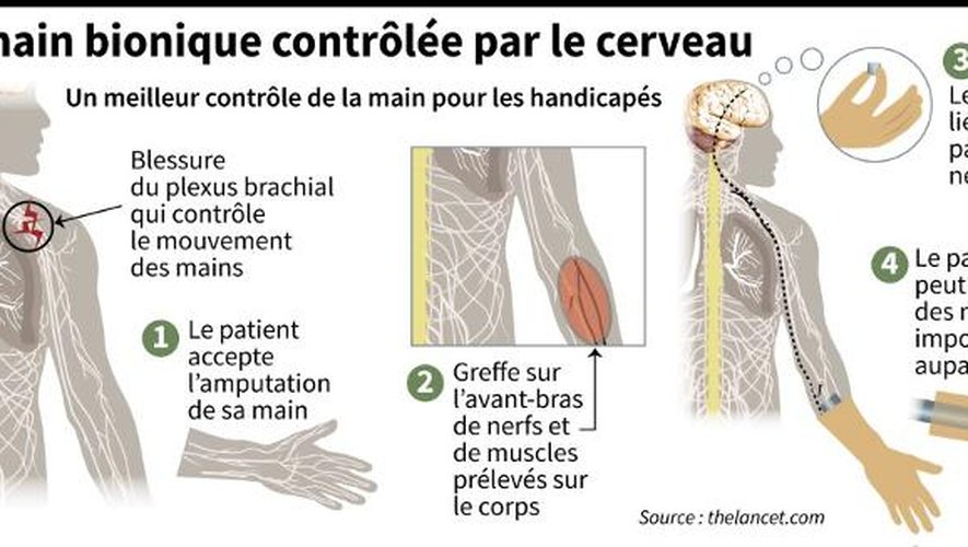 Description de la main bionique commandée par le cerveau