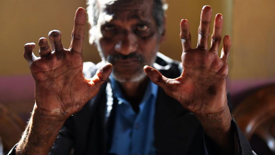 Un malade montre ses mains marquées par la lèpre, le 11 mars 2015 dans une "colonie de lépreux" à New Delhi
