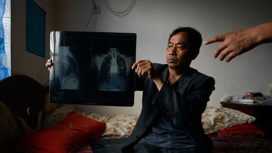 Xu Zhihui, souffrant de pneumoconioses, montre une radio de ses poumons, le 29 avril 2013, à Shuangxi, dans le Hunan (Chine)