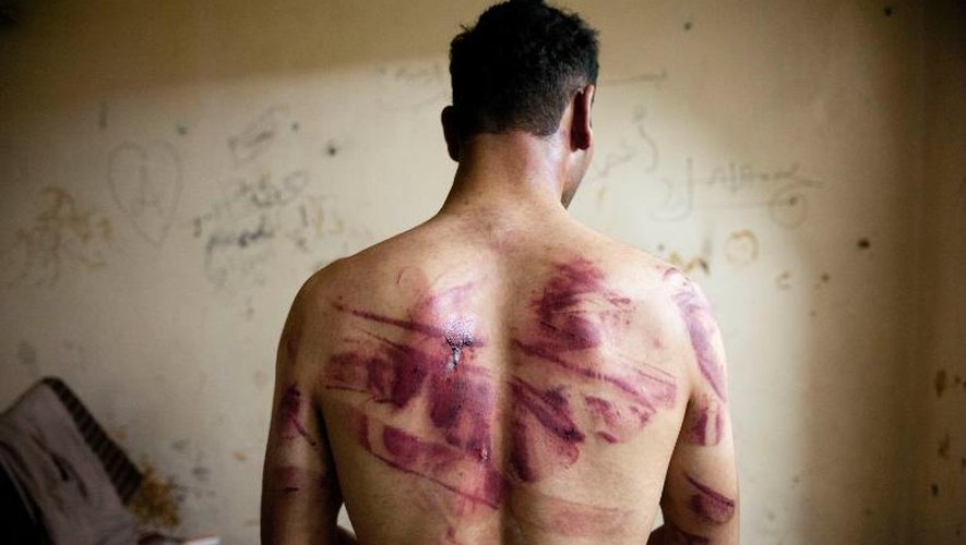 Un homme Syrien montre des marques sur son dos dûes aux violences pendant son emprisonnement dans les prisons du régime à Alep le 23 août 2012