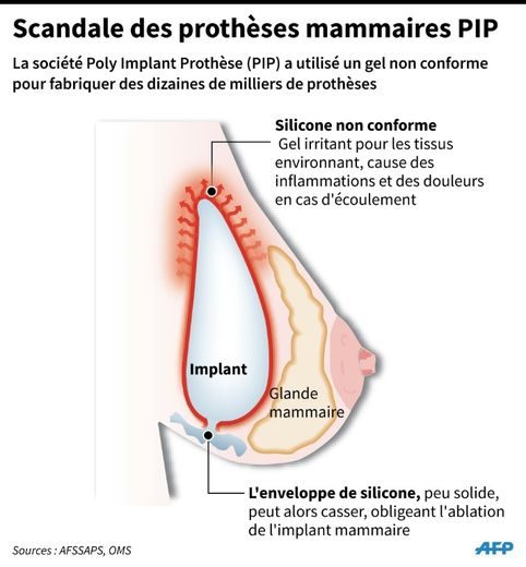 Scandale des prothèses mammaires PIP