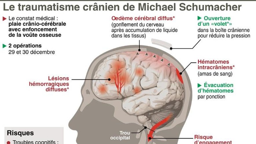 Schéma illustrant le traumatisme crânien de Michael Schumacher