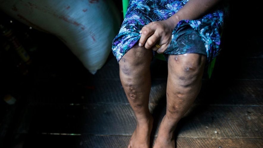 Than Than Ei montre des cicatrices sur ses jambes causées par les maltraitances dont elle a fait l'objet lorsqu'elle était esclave, le 29 septembre 2016, à Rangoon
