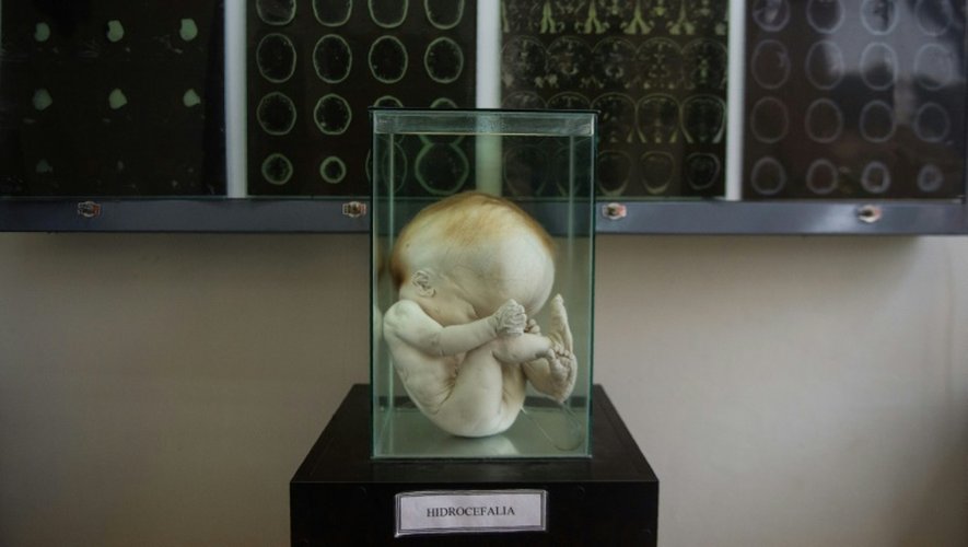 Un foetus humain atteint d'une pathologie cérébrale, l'hydrocéphalie, au musée de neuropathologie de Lima, le 16 novembre 2016
