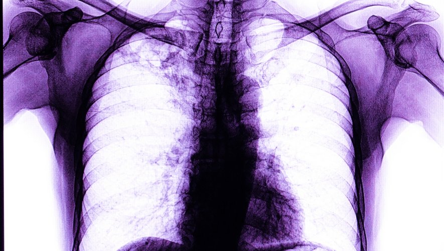 Tuberculose multirésistante : un virage à 180 degrés dans les traitements