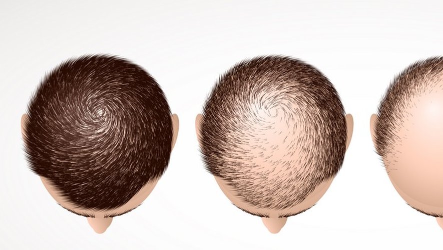 Alopécie : des médicaments contre l’eczéma font repousser les cheveux