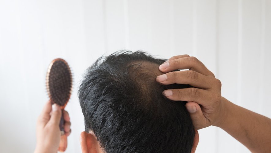 Chute de cheveux : traitement par finastéride à risque