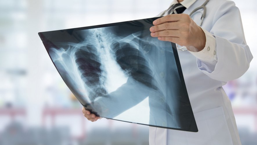 Tuberculose : 30 nouveaux cas par heure en Europe