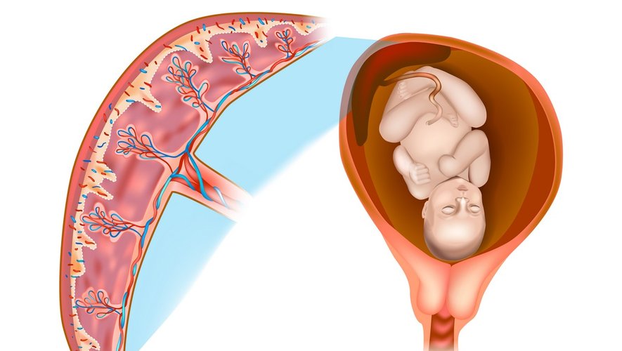 C’est quoi le placenta accreta ?