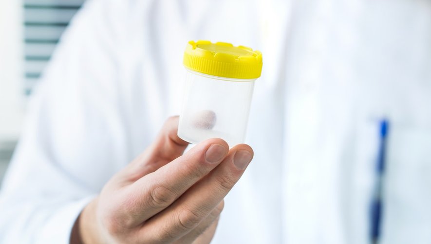 Un test urinaire pour dépister les cancers urothéliaux