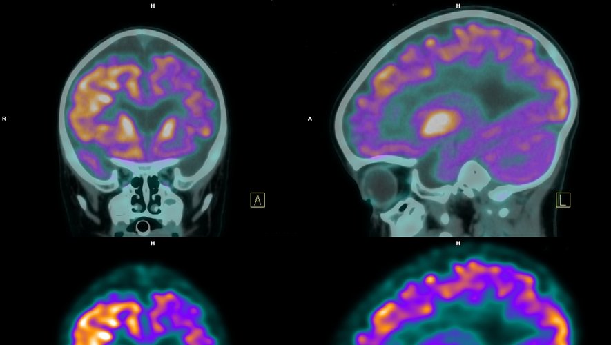 Cette recherche détaille une nouvelle méthode de diagnostic qui serait, selon les auteurs de l'étude, capable de détecter 91% des cas de maladies d'Alzheimer.
