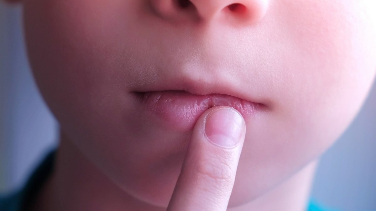 Herpes Chez L Enfant Impressionnante Primo Infection Centrepresseaveyron Fr