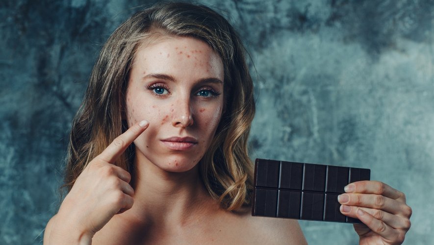 Sodas, sucreries, stress… ces facteurs qui aggravent l’acné