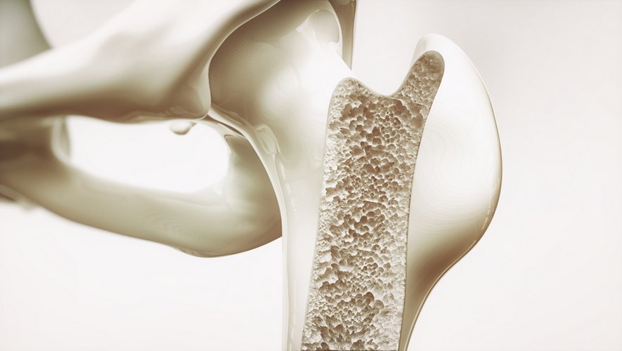 Ostéoporose : comment prévenir pour ne pas tomber sur un os ?
