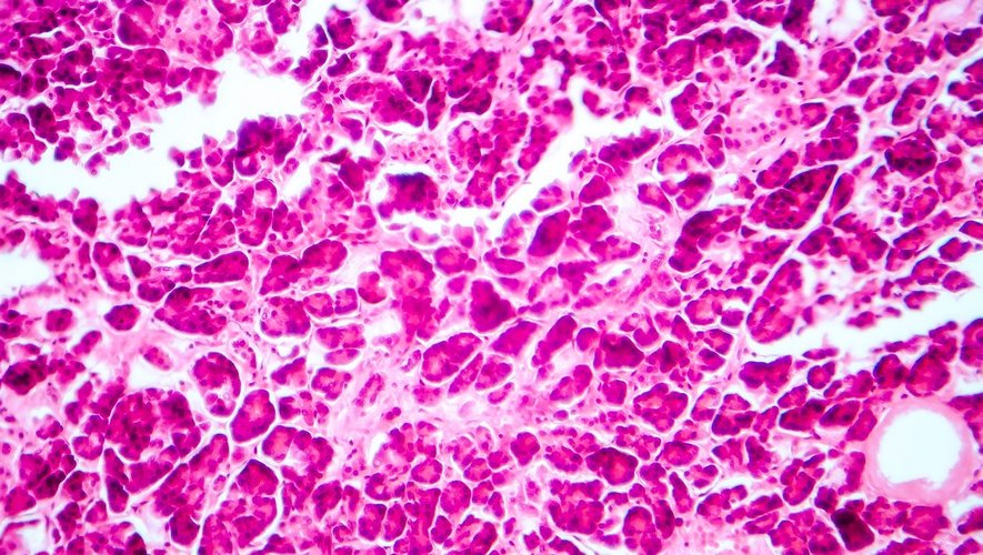 Diabète de type 1 : zoom sur la greffe de cellules pancréatiques