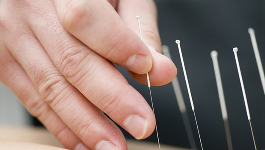 L'acupuncture pourrait permettre de traiter les migraines, à en croire une nouvelle étude chinoise.