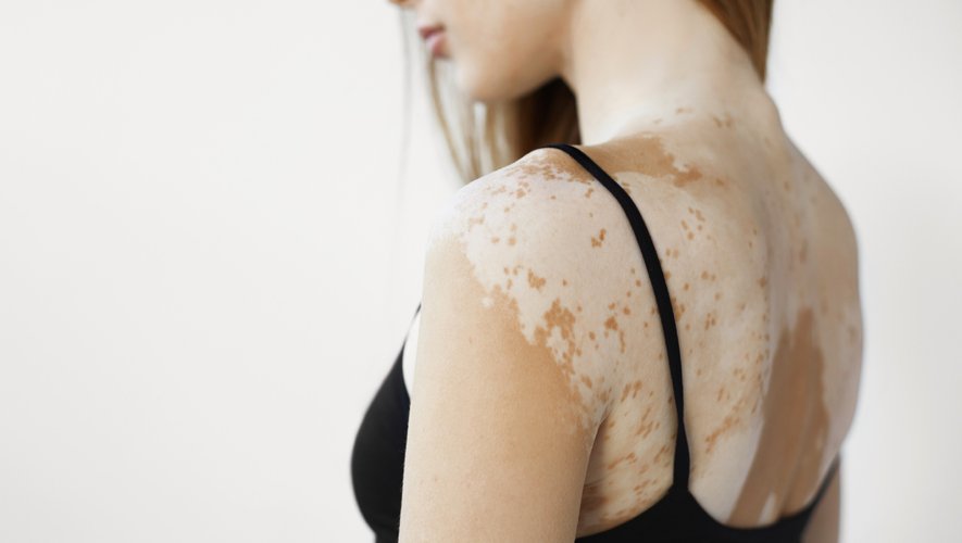 On estime que le vitiligo, maladie dermatologique qui se caractérise par une dépigmentation de la peau, touche 0,5 à 1% de la population mondiale et plus d'un million de personnes en France.