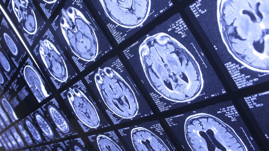 Une recherche réalisée par des médecins de l'université du Kentucky et parue dans la revue Jama Neurology décrit une forme complexe et encore mal connue de démence.