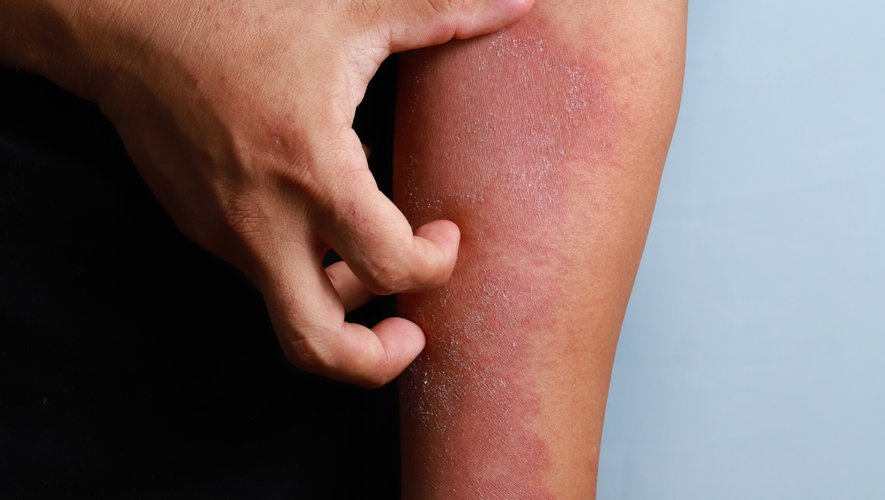 D'après une étude française réalisée en 2020, plus d'un ado souffrant d'une dermatite atopique sur trois (35%) déclare avoir déjà été en proie aux moqueries ou subi un isolement