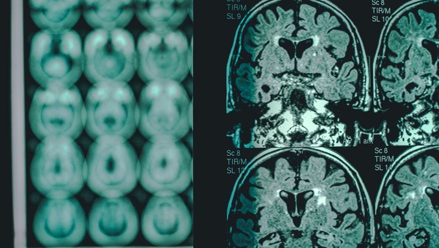 Commotion cérébrale, Alzheimer, Parkinson… bientôt un traitement universel ?
