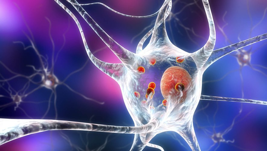 Baisse de l’audition, épilepsie : des signes précoces de Parkinson ?