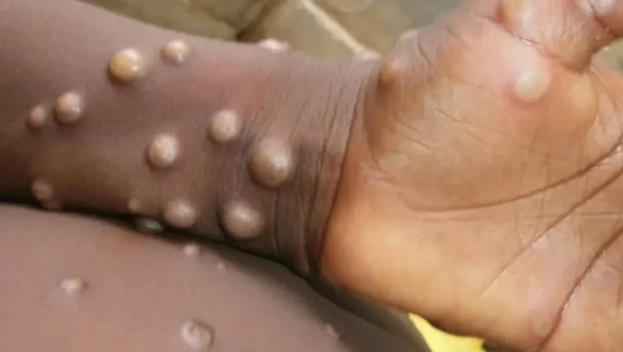 La variole du singe est caractérisée par l’apparition de lésions cutanées qui forment par la suite des croûtes, ressemblant à la varicelle.