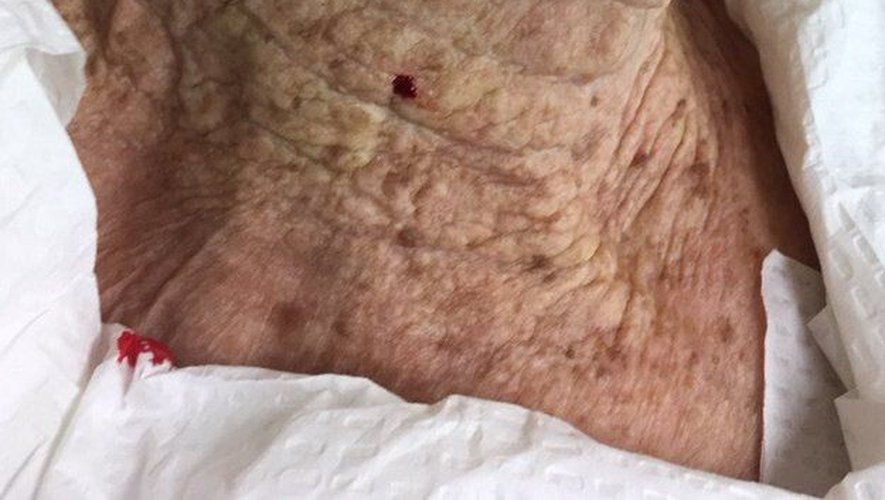 La photo de cette anonyme âgée de 92 ans montre les dégâts causés par le soleil sur une période de 40 ans.