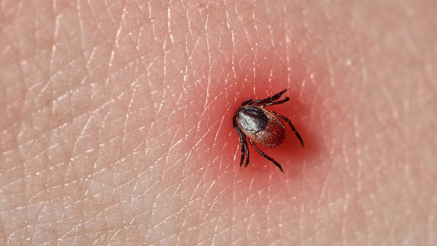 Maladie de Lyme : une explosion de cas aux Etats-Unis