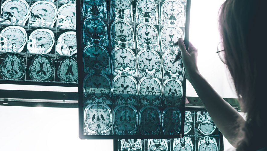 Dépistage précoce d’Alzheimer : où en est la recherche ?