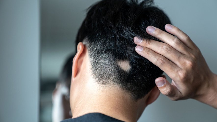 Perte de poils, de cheveux : c’est quoi l’alopécie ?