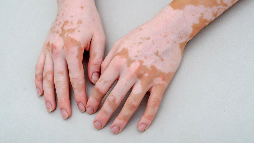 Vitiligo : les acariens impliqués dans la maladie