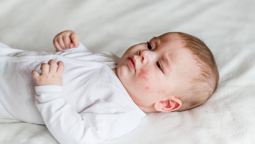Dermatite atopique sévère : la science progresse dans la prise en charge des bébés