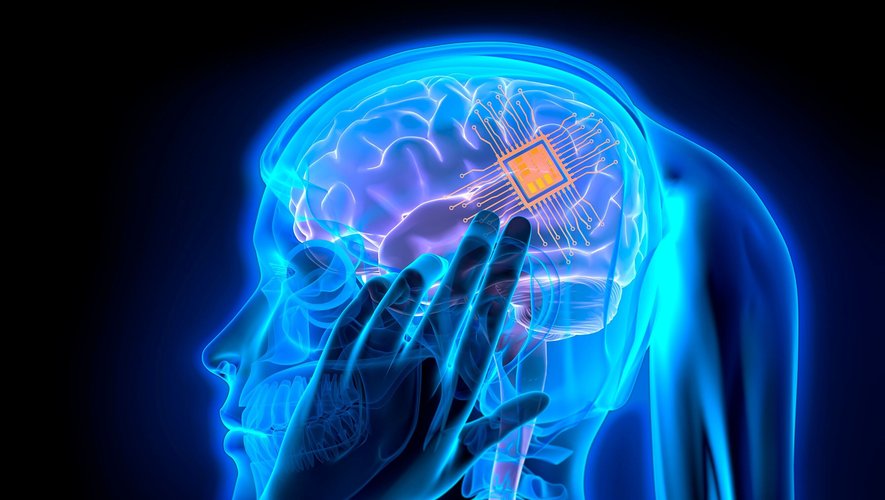 Neuralink annonce avoir implanté une première puce dans le cerveau d'un être humain.