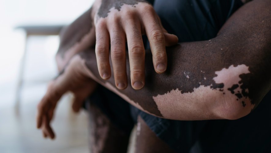 Vitiligo : un premier traitement autorisé et remboursé en France