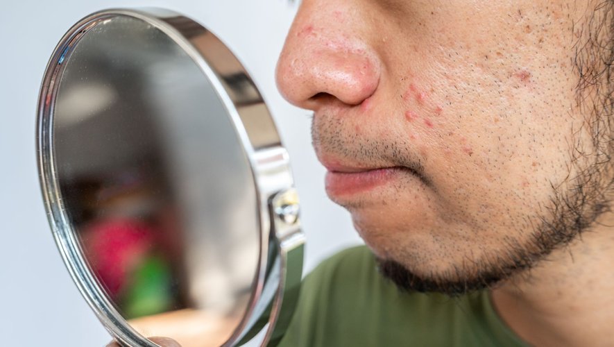 Un adulte sur cinq touchée par l’acné dans le monde