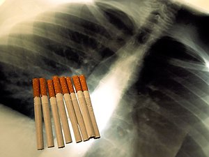 Cancer du poumon : faut-il s'enthousiasmer des innovations thérapeutiques de prise en charge ?