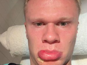 Porte du bus 1 - 0 Erling Haaland : la blessure insolite du joueur norvégien qui a dû se faire recoudre la lèvre