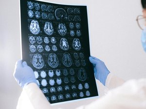 Alzheimer : quel est ce test capable de détecter en trois minutes les signes de la maladie avant son apparition ?
