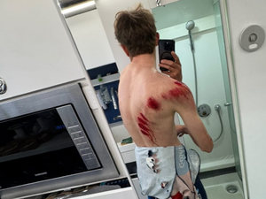 Cyclisme : Johan Blanc se fracture le poignet, au moins six semaines d'arrêt pour le Ruthénois