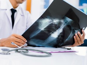Dépistage national du cancer du poumon : 20 000 volontaires recrutés, voici comment participer au programme et quelles sont les conditions pour être éligible ?